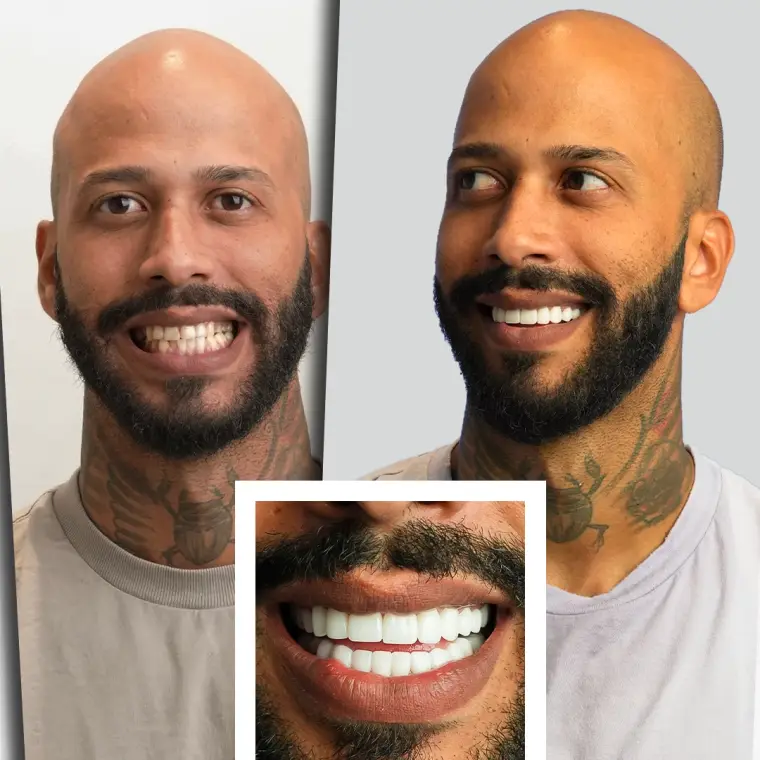 Kevin R. - Implanturi Dentare