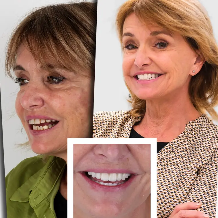 Ketty - Transformare Zâmbet